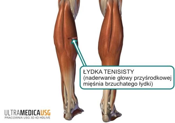 Pierwsza pomoc przy naderwaniu mięśnia