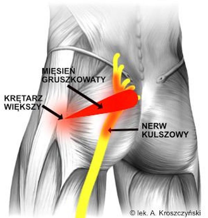 Wzmocnienie mięśnia gruszkowatego