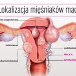 Jak rozpoznać objawy problemów z mięśniem macicy?