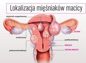 Jak rozpoznać objawy problemów z mięśniem macicy?