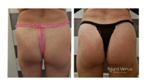 Sekrety pięknych pośladków: Jak podnieść je bez ćwiczeń?