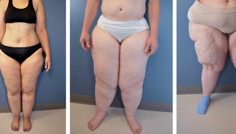 Skuteczna dieta dla osób z lipodemią – jak wspierać zdrowie i sylwetkę?