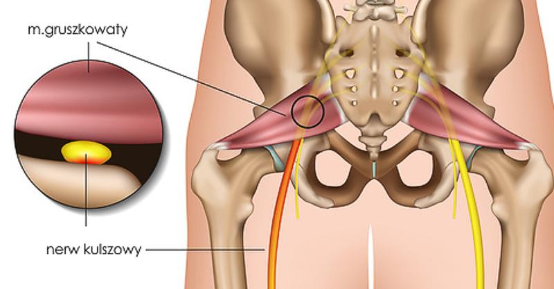Diagnostyka zespołu mięśnia gruszkowatego