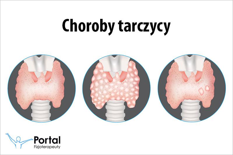 Dieta przy niedoczynności tarczycy