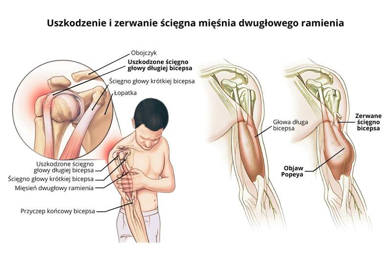 Objawy zerwania mięśnia barku