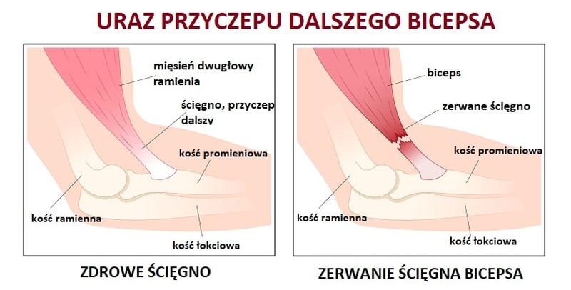 Pierwsza pomoc przy naciągnięciu dwugłowego uda