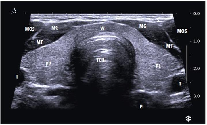 Problemy i profilaktyka mięśni trapezoidalnych
