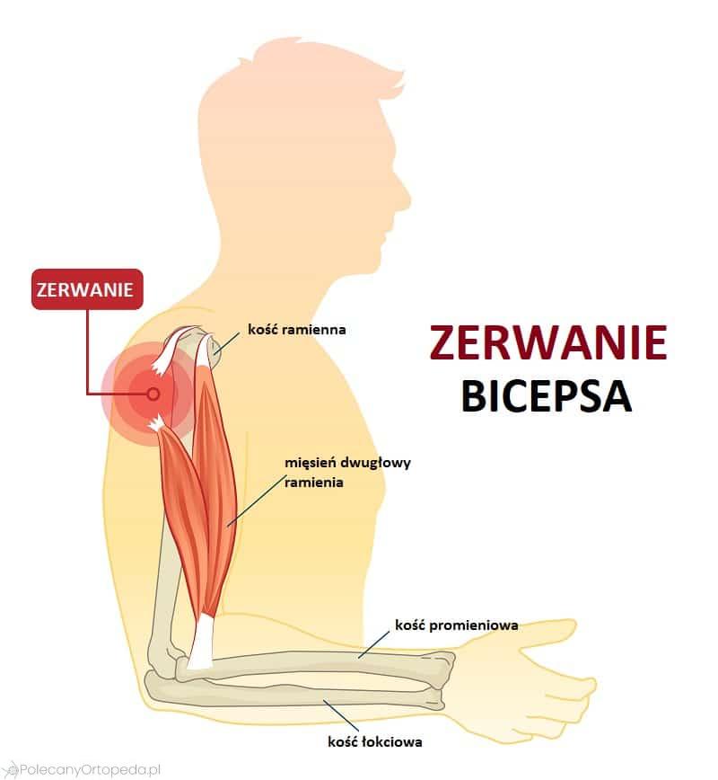 Rehabilitacja po zerwaniu mięśnia barku