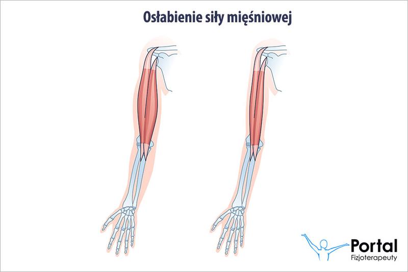 Zwiotczenie mięśni u dzieci