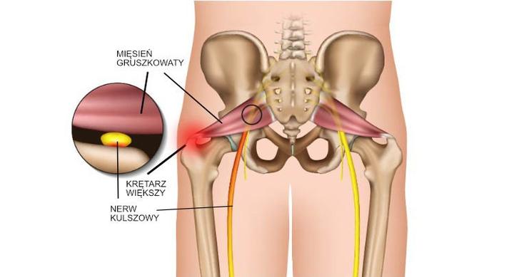 Jak rozpoznać objawy zespołu mięśnia gruszkowatego?