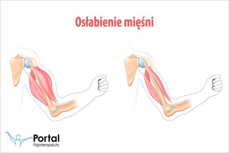 Zwiotczenie mięśni – poznaj przyczyny i objawy, które warto znać