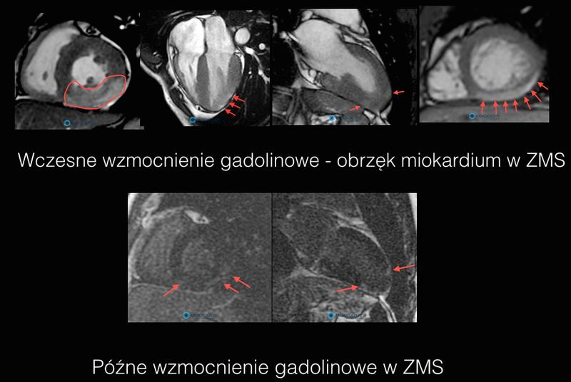 Czas trwania zapalenia mięśnia sercowego