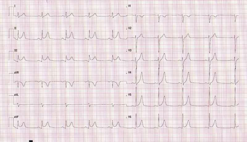 Czynniki ryzyka zapalenia mięśnia sercowego