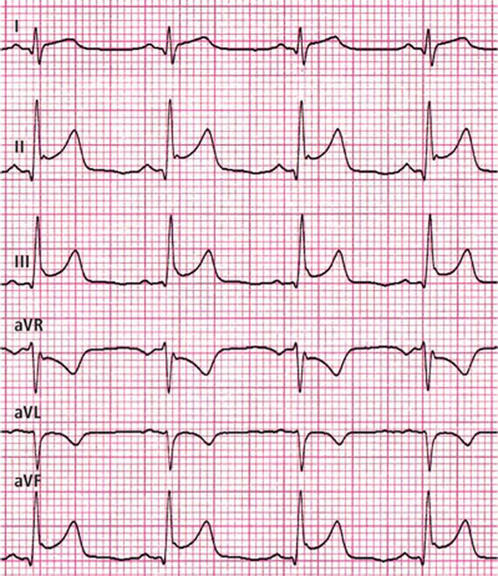 Objawy zapalenia mięśnia sercowego