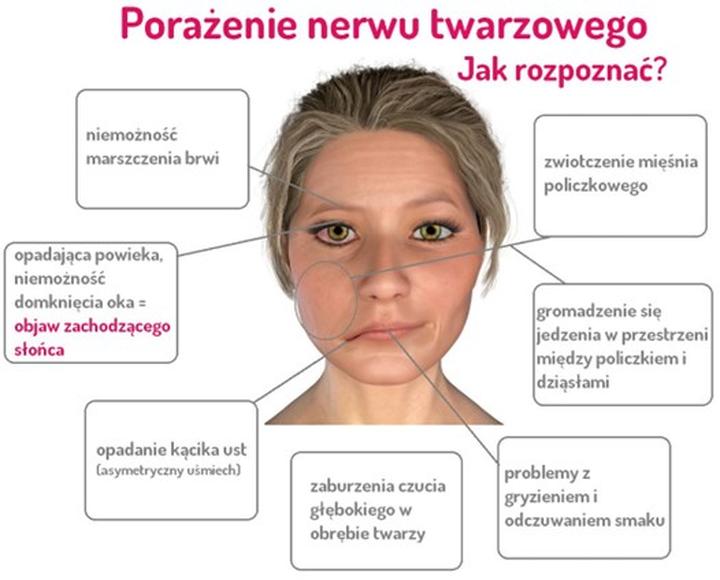 Rehabilitacja po porażeniu nerwu