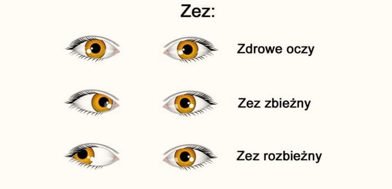 Rehabilitacja zeza u dzieci