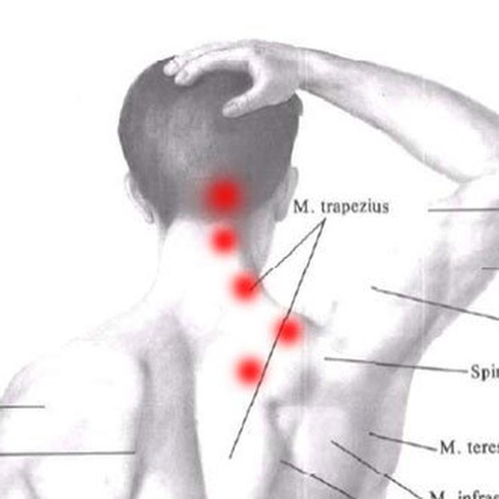 Zapalenie mięśni szyi